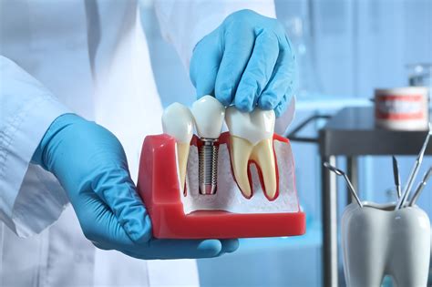 Qu Pasa Si Fumo Y Tengo Implantes Dentales Cl Nica Dental Azuqueca