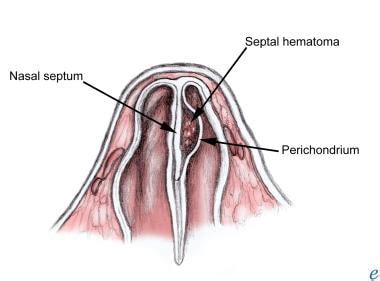 Nasal Septal Hematoma