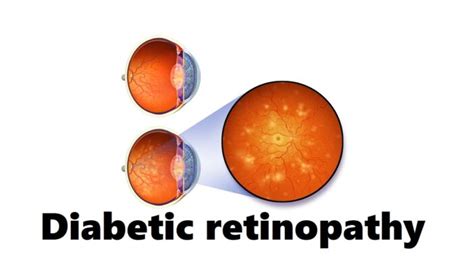 Diabetic Retinopathy Definition Causes 6 Risk Factors Symptoms And