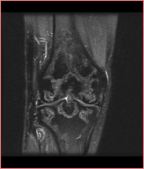 Bone infarction - wikidoc