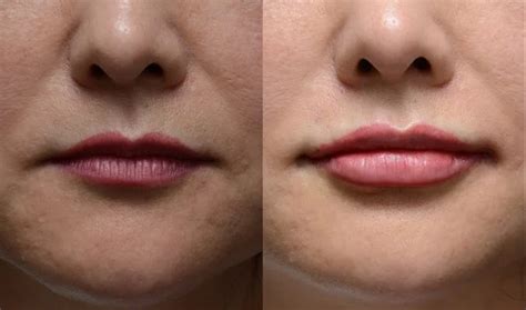 Lip Filler Injection Dr Peter Kim Surgery Skin Cancer Cosmetic