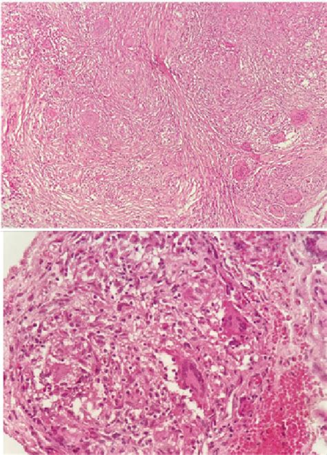 Anatomopathological Examination Showing Granulomatous Epithelioid And