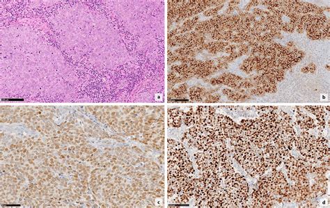 Morphological Features Of Merkel Cell Carcinoma With Large Cell