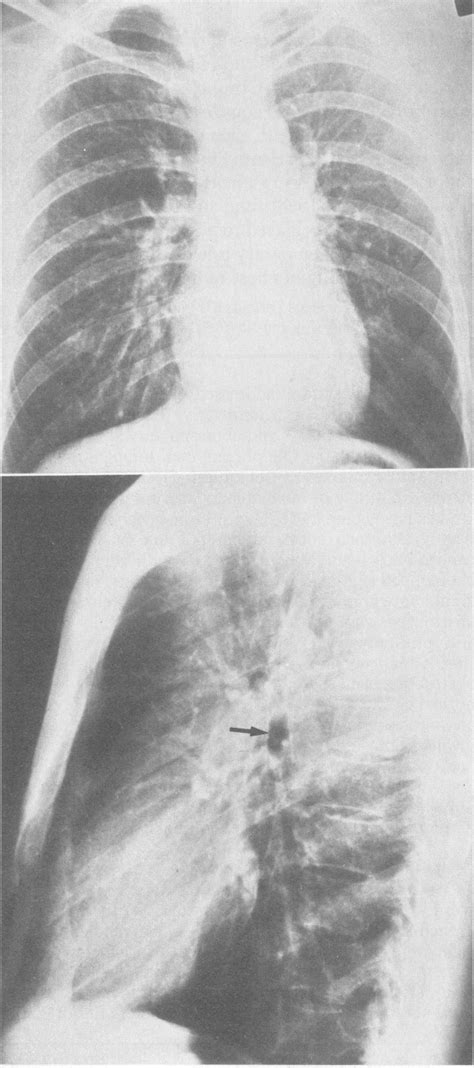 On Posteroanterior Top And Lateral Bottom Chest Radiographs Of