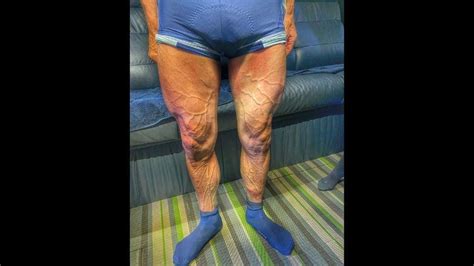 Cyclist shares picture of his veiny ‘Hulk-like’ legs after a race in ...