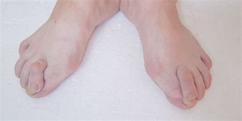 There Are Several Causes For Overlapping Toes Which In Turn Can Cause Problems Get To The