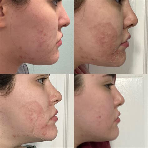 Vi Peel Review 2023 I Tested The Chemical Peel For