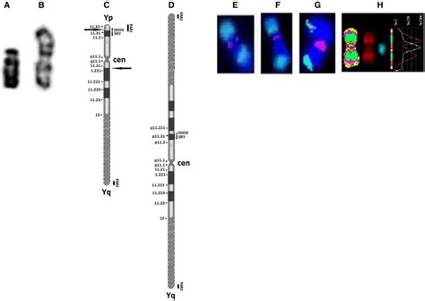 Fish And Array Cgh Characterization Of De Novo Derivative Y Chromosome