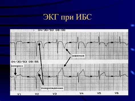 Классификация ИБС (ВКНЦ) - online presentation