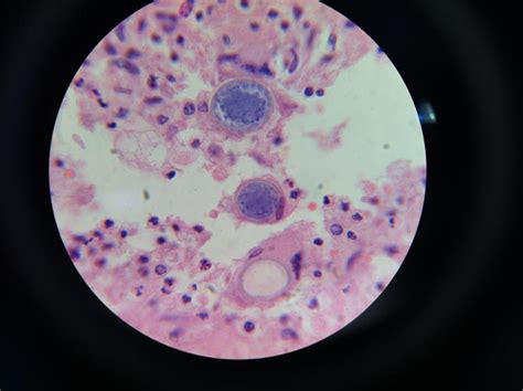 Kokzidioidomykose - DocCheck
