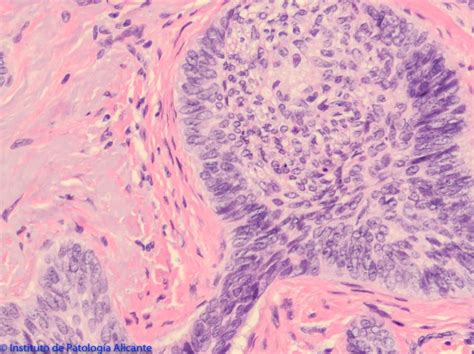 Carcinoma Basocelular Instituto De Patología Alicante Ipa