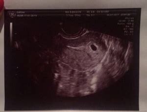 Ultrasound At 5w5d Anyone Have Pics That Early March 2018 Babies