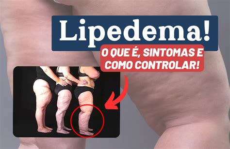 Lipedema Conhe A Os Sintomas Diagn Stico E Tratamentos Blog Dr Alex