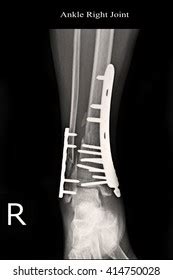 Ankle Right Joint Fracture Ankle Right Stock Photo 414750028 | Shutterstock