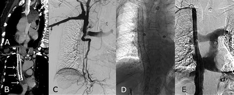 Bridging Stent Placement In Vena Cava Syndrome With Tumor Thrombotic