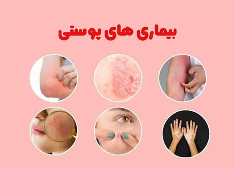 اسم انواع بیماری پوستی شایع و خطرناک تصاویر