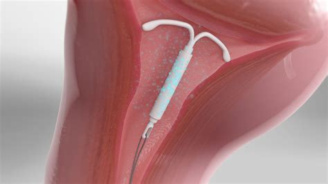 Mirena Iud In Cervix