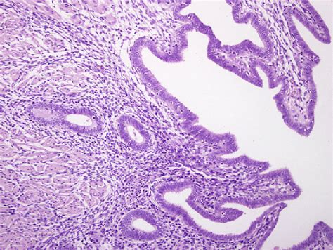 Figure3×200 Endometrial Mucosa And The Surrounding Stroma In The