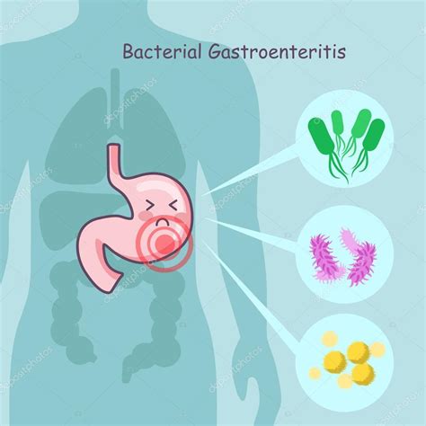 Enteritis As Related To Bacterial Gastroenteritis Pictures