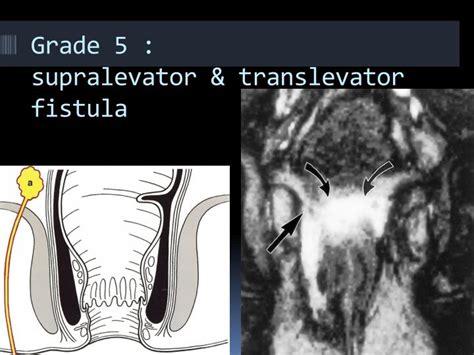 Ppt Mri Imaging Of Perianal Fistula Powerpoint Presentation Id