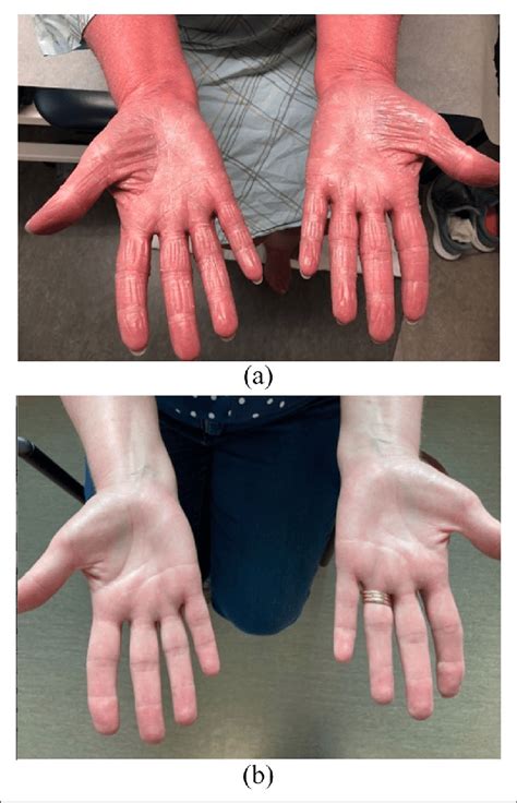 A Palmar Keratoderma B Complete Resolution After Months Therapy