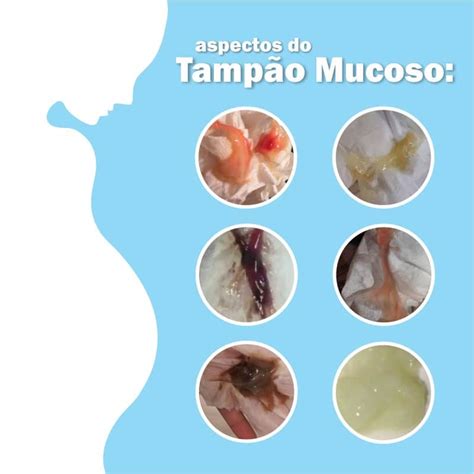 Saída do tampão mucoso o que é como se parece como reconhecer e para