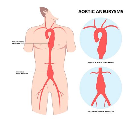 What is Aortic Root Dilatation? - Showit Blog