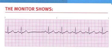 Cardiac Arrhythmia Flashcards Quizlet