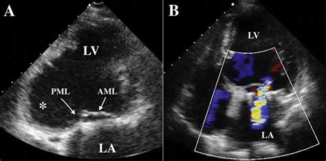 A Postoperative Transthoracic Echocardiography Showing Left