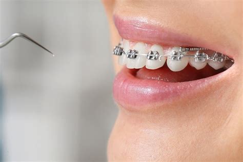 What To Expect Your First Orthodontic Visit Gulfside Dental