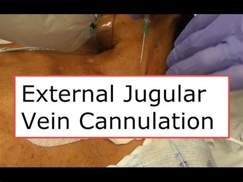 Proper Technique For Internal Jugular Cannulation, 52% OFF