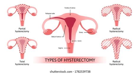 Hysterectomy Photos and Images | Shutterstock