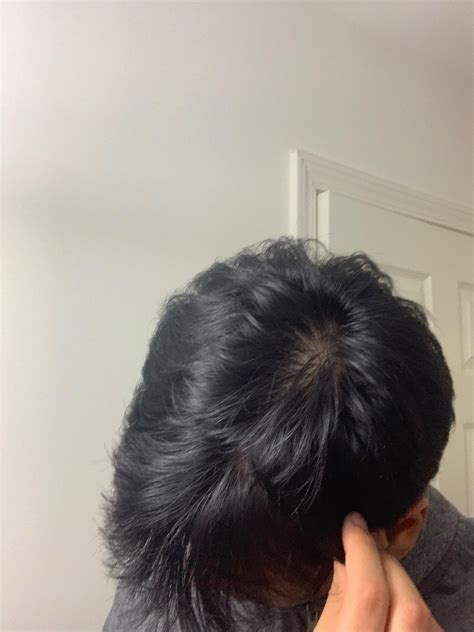 Diffuse thinning? : r/Hairloss