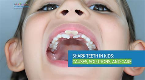 Shark Teeth in Kids: Causes, Solutions, and Dental Care