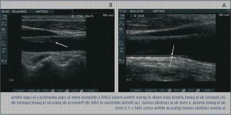 Las Mejores Ecograf As Arteriales De Car Tidas Mes