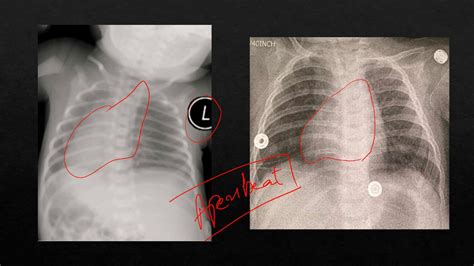 Esophageal Atresia X Ray