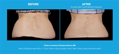 Coolsculpting Dermatology Consultants