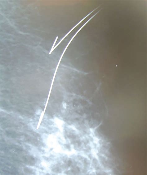 Figure 1 From Diagnostic Value Of Hook Wire Localization Technique For