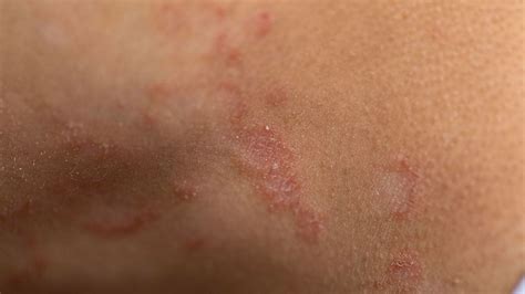 Ringworm In Humans Treatment