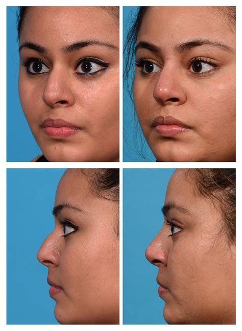 Liquid Rhinoplasty Before And After Pictures