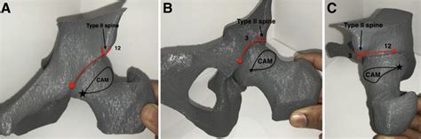 Preoperative Planning For Pincer And Cam Resection On 3 Dimensional Download Scientific Diagram