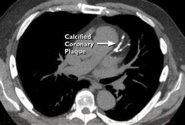 Coronary Artery Calcium Score Kippax Medical Imaging