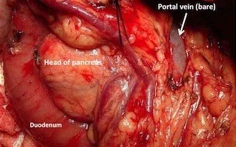 急性胰腺炎图片 急性胰腺炎症状表现图片大全 有来医生