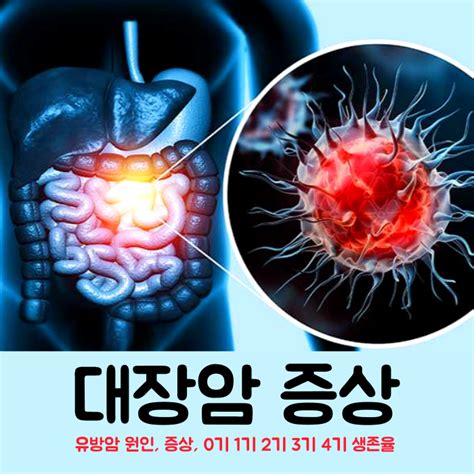 대장암 초기증상말기 및 3기 4기 생존율 혈변 가는변 점액변 대장암 원인 네이버 블로그