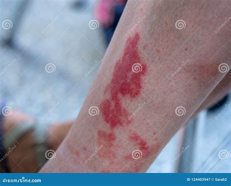 Vasculitis Symptoms Rash