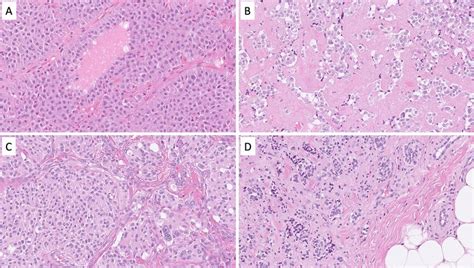 Differential diagnosis of a neuroendocrine carcinoma: Morphological ...