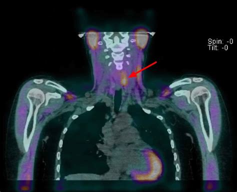 Parathyroid adenoma causes, symptoms, diagnosis, treatment & prognosis