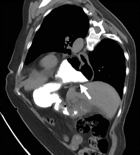 CT Esophagography For Evaluation Of Esophageal Perforation RadioGraphics