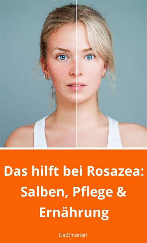 Das hilft bei Rosazea Salben Pflege Ernährung eatsmarter de