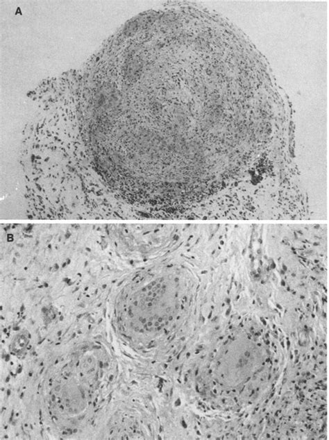 Histologic Peritoneal Biopsy With A Low Power Photomicrograph